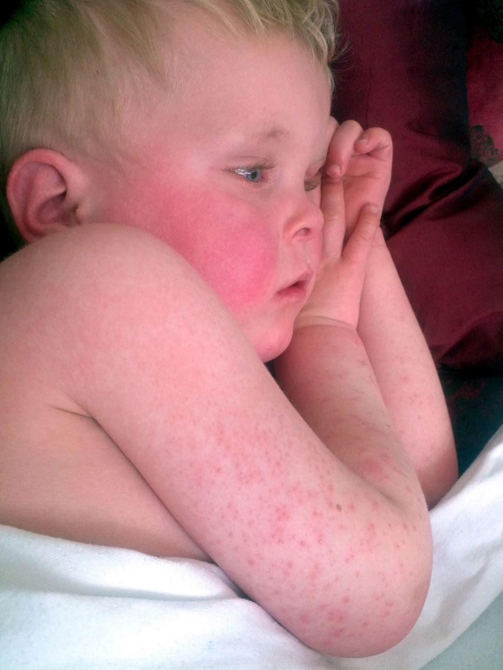 Klinisk diagnostisert tilfelle med skarlagensfeber med karakteristiske røde kinn og utslett. Foto: www.badobadop.co.uk