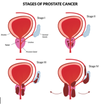 Stadier av prostatakreft illustrasjon