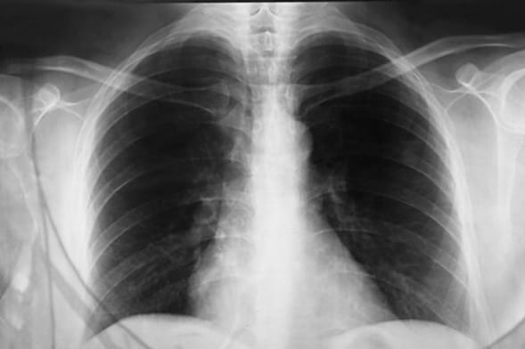 Røntgenbilde av lunger