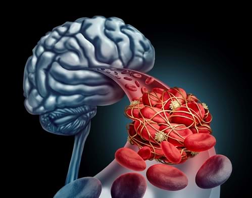 Colourbox. Blood clot brain medical concept as 3D illustration.