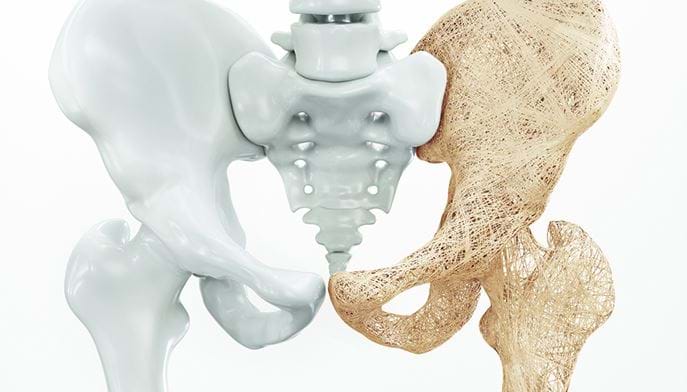 Illustrasjon av et hofteben med osteperose. Bilde fra Istockphoto.com Foto: CreVis2