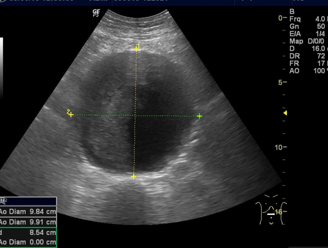Eksempel p&aring; bruk av ultralyd i allmennpraksis. Abdominal aortaaneurisme oppdaga grunna pasientens subjektive opplevelse av pulsering i abdomen. Samtykke til undervisingsbruk fr&aring; pasient