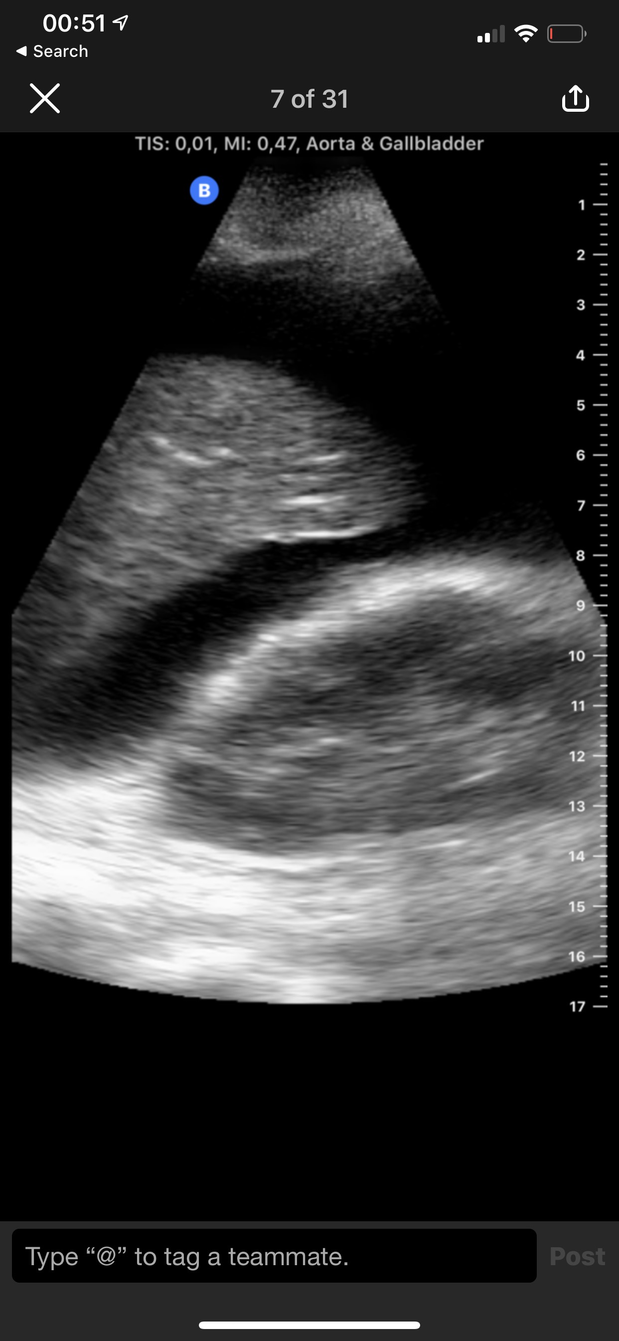 Eksempel p&aring; bilete fr&aring; Butterfly iQ. Massiv ascites hj&aring; kreftpasient. Lever og h&oslash;gre nyre. Samtykke til undervisingsbruk fr&aring; pasient.