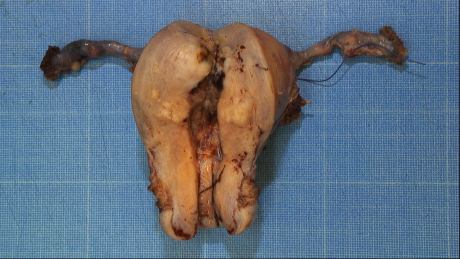 uterus