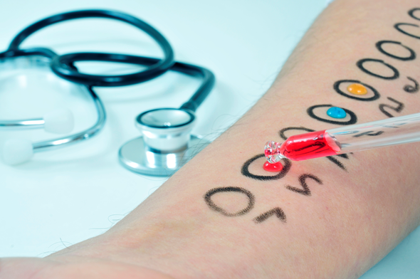 Allergitest på en arm med et stetoskop ved siden av. Illustrasjonsfoto: Colourbox.com
