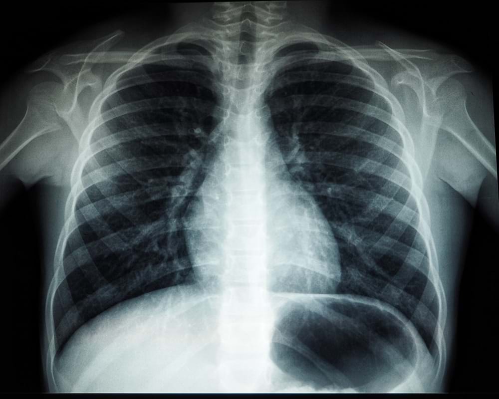 R&#248;ntgenbilde av lunger.