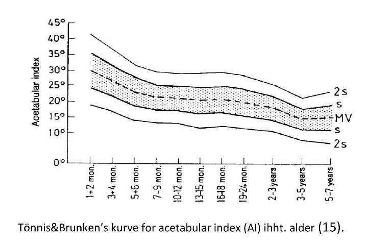 Acetabular index - illustrasjon