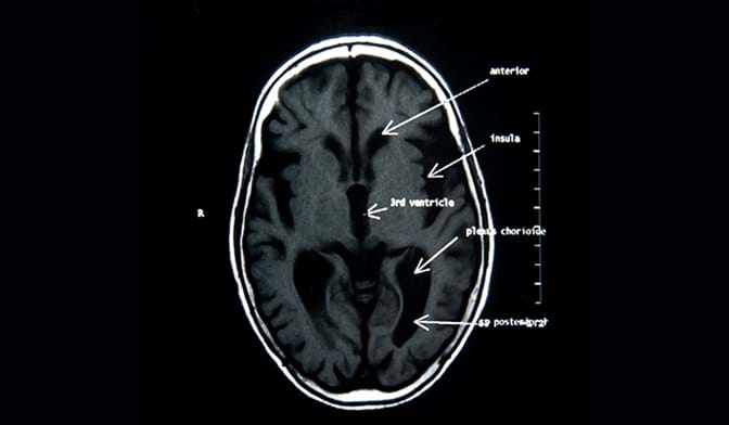 MR av hjernen med forklaringer. Foto: Colourbox.com