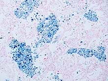 220px-Intra-alveolar_hemosiderin_deposition_-_Prussian_blue_stain